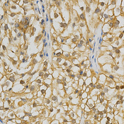 Immunohistochemistry of paraffin-embedded human kidney cancer using ADRBK2 antibody at dilution of 1:200 (x400 lens)