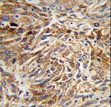 Formalin-fixed and paraffin-embedded human lung carcinoma reacted with AGR3 Antibody , which was peroxidase-conjugated to the secondary antibody, followed by DAB staining. This data demonstrates the use of this antibody for immunohistochemistry; clinical relevance has not been evaluated.