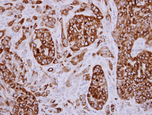 IHC of paraffin-embedded A549 xenograft using AGR3 antibody at 1:500 dilution.