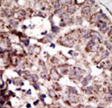 Formalin-fixed and paraffin-embedded human cancer tissue reacted with the primary antibody, which was peroxidase-conjugated to the secondary antibody, followed by AEC staining. This data demonstrates the use of this antibody for immunohistochemistry; clinical relevance has not been evaluated. BC = breast carcinoma; HC = hepatocarcinoma.