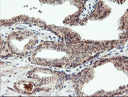 IHC of paraffin-embedded Carcinoma of Human prostate tissue using anti-AGPAT5 mouse monoclonal antibody.