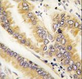 Formalin-fixed and paraffin-embedded human lung carcinoma tissue reacted with AGR2 antibody , which was peroxidase-conjugated to the secondary antibody, followed by DAB staining. This data demonstrates the use of this antibody for immunohistochemistry; clinical relevance has not been evaluated.