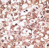 Formalin-fixed and paraffin-embedded human cancer tissue reacted with the primary antibody, which was peroxidase-conjugated to the secondary antibody, followed by AEC staining. This data demonstrates the use of this antibody for immunohistochemistry; clinical relevance has not been evaluated. BC = breast carcinoma; HC = hepatocarcinoma.