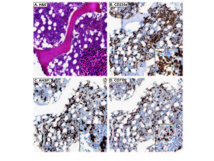 Immunohistochemistry of Rabbit anti-AHSP antibody. Tissue: A. Normal bone marrow, H&E. B. CD235a stains both nucleated EPs and mature, anucleate RBCs. C. AHSP stains nucleated EPs, but not mature, anucleate RBCs. D. CD71 stains nucleated EPs, but not mature, anucleate RBCs. Fixation: acetic acid-zinc-formalin and formalin fixation, embedded in paraffin Antigen retrieval: TRIS-EDTA pH9.0 Primary antibody: AHSP antibody at 1:8000 for overnight at 4°C Secondary antibody: anti-rabbit secondary at (1:10000 for 45 min at RT) Localization: Anti-AHSP is cytoplasmic Staining: AHSP antibody as precipitated brown signal with a purple nuclear counterstain using Bond-max fully automated for IHC.