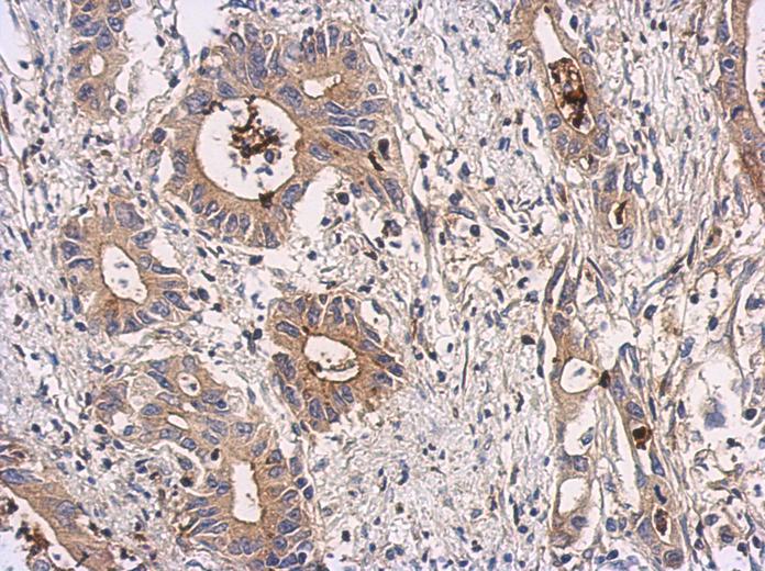IHC of paraffin-embedded Colon ca using ATIC antibody at 1:100 dilution.