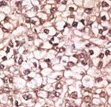 Formalin-fixed and paraffin-embedded human cancer tissue reacted with the primary antibody, which was peroxidase-conjugated to the secondary antibody, followed by AEC staining. This data demonstrates the use of this antibody for immunohistochemistry; clinical relevance has not been evaluated. BC = breast carcinoma; HC = hepatocarcinoma.