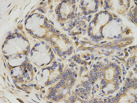 Immunohistochemistry of paraffin-embedded human thyroid cancer using ATIC antibody at dilution of 1:200 (400x lens).