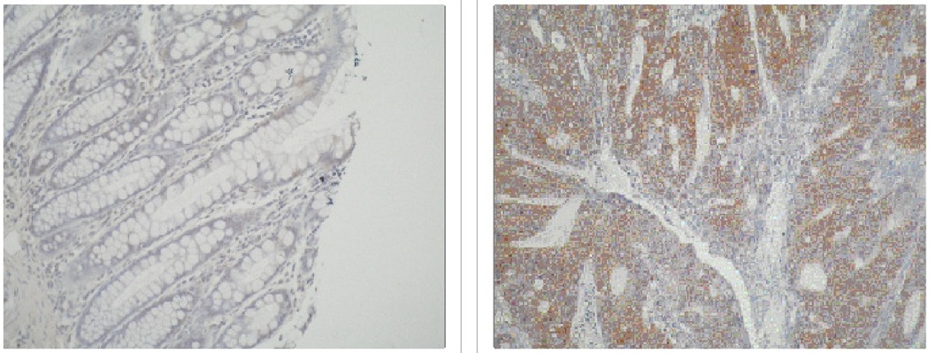 Left and Center: IHC of normal colon tissue and colon carcinoma tissue using ATIC antibody (LS-C27035). Right: Western blot of ATIC antibody on HT29 cell lysate.
