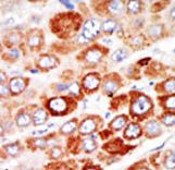Formalin-fixed and paraffin-embedded human cancer tissue reacted with the primary antibody, which was peroxidase-conjugated to the secondary antibody, followed by AEC staining. This data demonstrates the use of this antibody for immunohistochemistry; clinical relevance has not been evaluated. BC = breast carcinoma; HC = hepatocarcinoma.