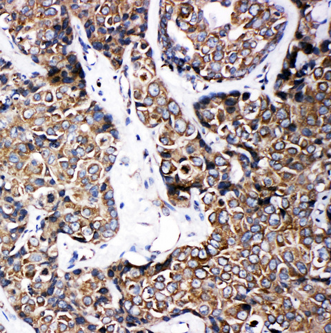 ABCB6 antibody. IHC(P): Human Breast Cancer Tissue.