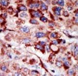 Formalin-fixed and paraffin-embedded human cancer tissue reacted with the primary antibody, which was peroxidase-conjugated to the secondary antibody, followed by AEC staining. This data demonstrates the use of this antibody for immunohistochemistry; clinical relevance has not been evaluated. BC = breast carcinoma; HC = hepatocarcinoma.