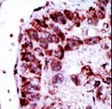 Formalin-fixed and paraffin-embedded human cancer tissue reacted with the primary antibody, which was peroxidase-conjugated to the secondary antibody, followed by DAB staining. This data demonstrates the use of this antibody for immunohistochemistry; clinical relevance has not been evaluated. BC = breast carcinoma; HC = hepatocarcinoma.