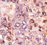 Formalin-fixed and paraffin-embedded human cancer tissue reacted with the primary antibody, which was peroxidase-conjugated to the secondary antibody, followed by DAB staining. This data demonstrates the use of this antibody for immunohistochemistry; clinical relevance has not been evaluated. BC = breast carcinoma; HC = hepatocarcinoma.