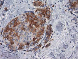 IHC of paraffin-embedded Adenocarcinoma of Human breast tissue using anti-AK5 mouse monoclonal antibody.