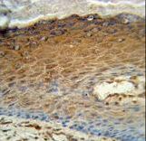 AK7 Antibody immunohistochemistry of formalin-fixed and paraffin-embedded human skin carcinoma followed by peroxidase-conjugated secondary antibody and DAB staining.