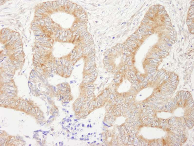Detection of Human AKAP1 by Immunohistochemistry. Sample: FFPE section of human colon carcinoma. Antibody: Affinity purified rabbit anti-AKAP1 used at a dilution of 1:200 (1 ug/ml).