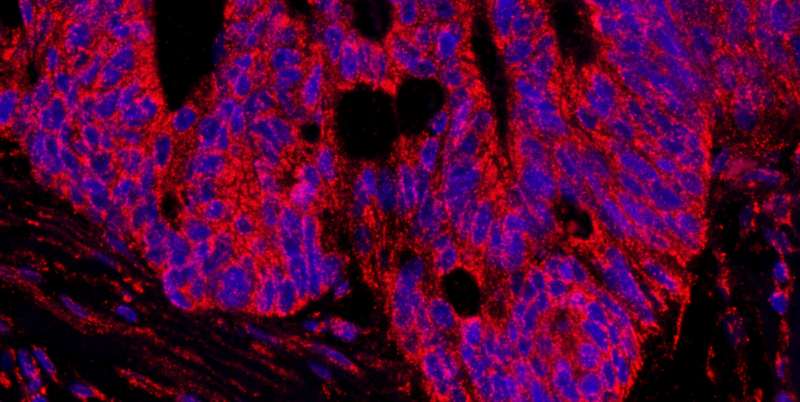Detection of Human AKAP1 by Immunohistochemistry. Sample: FFPE section of human prostate carcinoma. Antibody: Affinity purified rabbit anti-AKAP1 used at a dilution of 1:100 (2 ug/ml). Detection: Red-fluorescent goat anti-rabbit IgG highly cross-adsorbed Antibody.