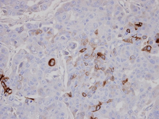 IHC of paraffin-embedded OVCAR3 using AKAP10 antibody at 1:100 dilution.