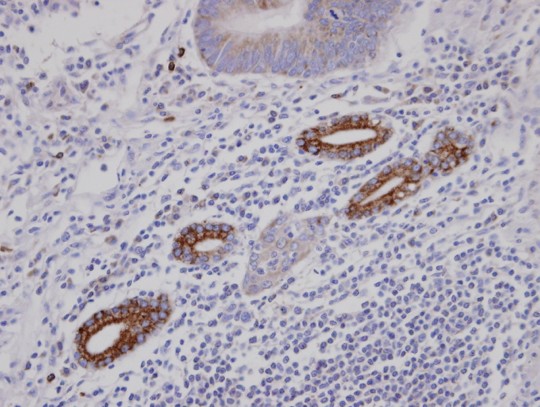 IHC of paraffin-embedded T (gastric CA) using AKAP10 antibody at 1:100 dilution.