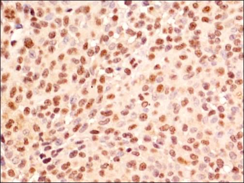 Immunohistochemistry: HA95/AKAP8L Antibody - IHC of HA95/AKAP8L in human ovarian cancer using DAB with hematoxylin counterstain.