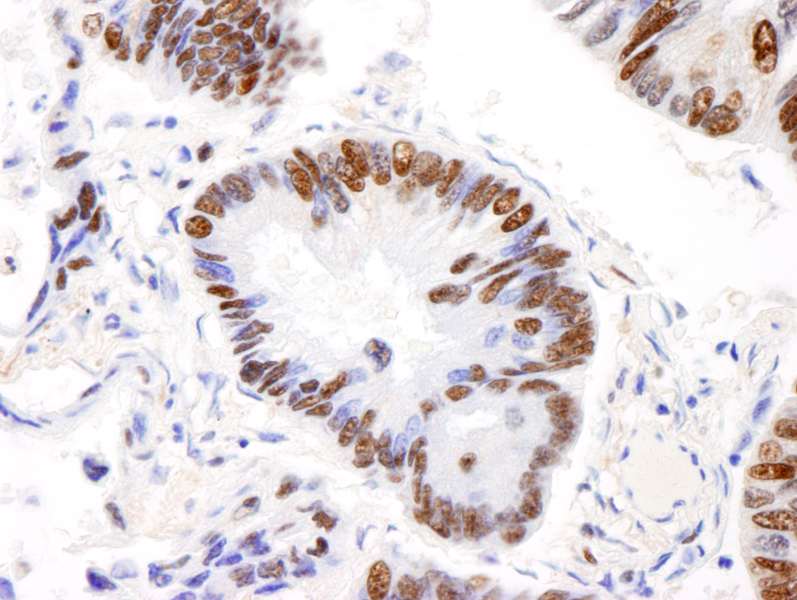 Detection of Human AKAP8L/HA95 by Immunohistochemistry. Sample: FFPE section of human lung carcinoma. Antibody: Affinity purified rabbit anti-AKAP8L/HA95 used at a dilution of 1:200 (1 ug/ml).