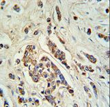 ABCC11 Antibody IHC of formalin-fixed and paraffin-embedded breast carcinoma followed by peroxidase-conjugated secondary antibody and DAB staining.