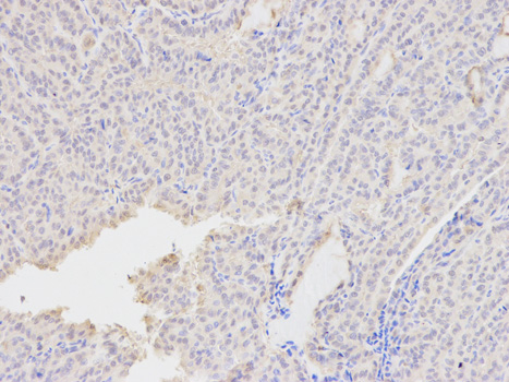 Immunohistochemistry of paraffin-embedded human thyroid cancer using AKR1A1 antibody at dilution of 1:400 (200x lens).