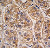 Formalin-fixed and paraffin-embedded human hepatocarcinoma tissue reacted with AKR1A1 antibody , which was peroxidase-conjugated to the secondary antibody, followed by DAB staining. This data demonstrates the use of this antibody for immunohistochemistry; clinical relevance has not been evaluated.