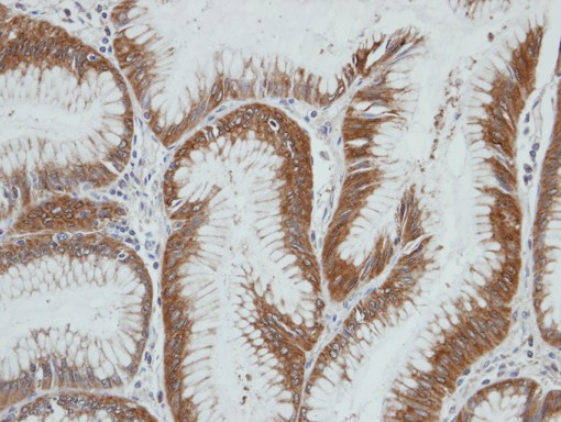IHC of paraffin-embedded gastric ca using AKR1C4 antibody at 1:100 dilution.
