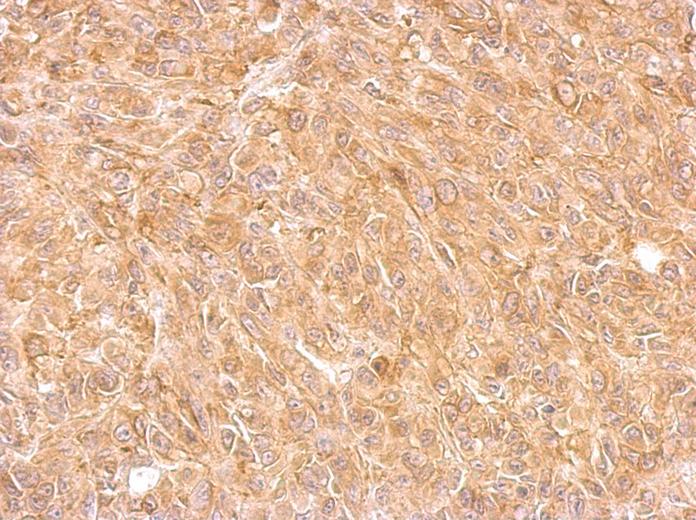 AKR7A2 antibody detects AKR7A2 protein at cytosol on SkHep1 xenograft by immunohistochemical analysis. Sample: Paraffin-embedded SkHep2 xenograft. AKR7A2 antibody dilution:1:500.