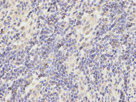 Immunohistochemistry of paraffin-embedded human kidney cancer using AKR7A2 antibody at dilution of 1:200 (400x lens).