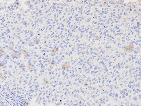 Immunohistochemistry of paraffin-embedded human liver cancer using AKR7A2 antibody at dilution of 1:200 (200x lens).