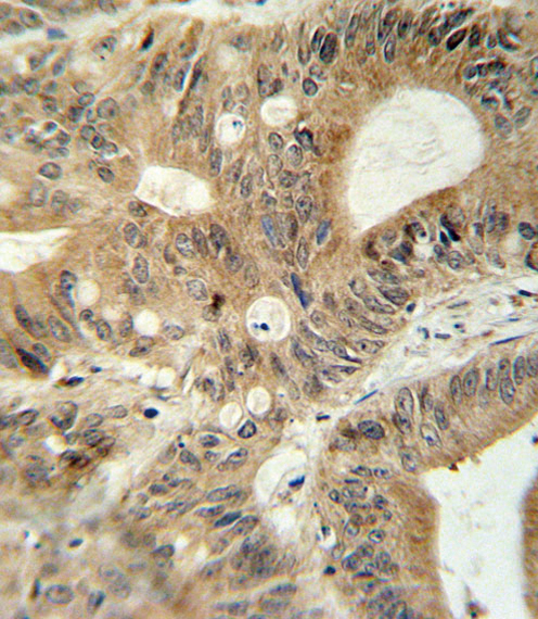 ABCC3 antibody immunohistochemistry of formalin-fixed and paraffin-embedded human colon carcinoma followed by peroxidase-conjugated secondary antibody and DAB staining.