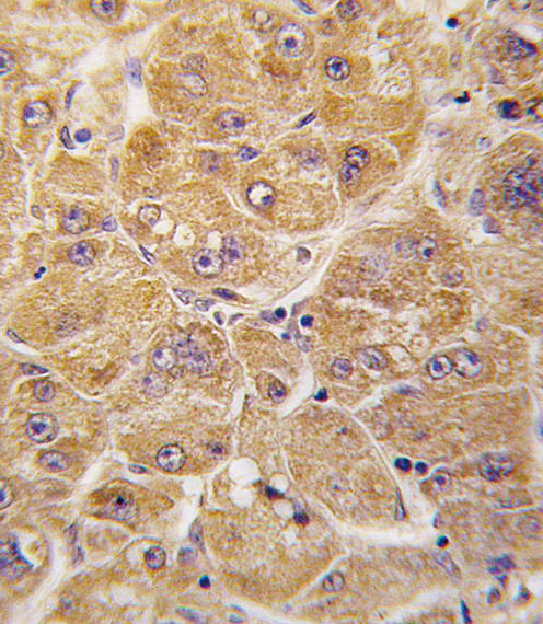 Formalin-fixed and paraffin-embedded human hepatocarcinoma tissue reacted with ALDH1A1 antibody , which was peroxidase-conjugated to the secondary antibody, followed by DAB staining. This data demonstrates the use of this antibody for immunohistochemistry; clinical relevance has not been evaluated.