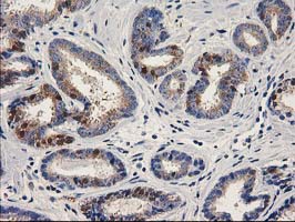 IHC of paraffin-embedded Carcinoma of Human prostate tissue using anti-ALDH1A3 mouse monoclonal antibody.
