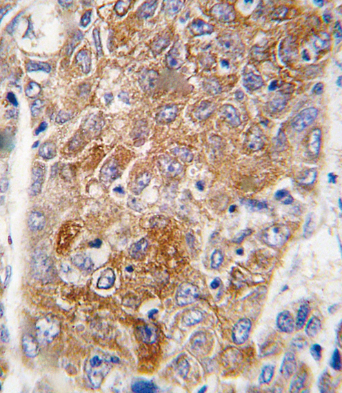 Formalin-fixed and paraffin-embedded human hepatocarcinoma tissue reacted with ALDH1L1 antibody , which was peroxidase-conjugated to the secondary antibody, followed by DAB staining. This data demonstrates the use of this antibody for immunohistochemistry; clinical relevance has not been evaluated.