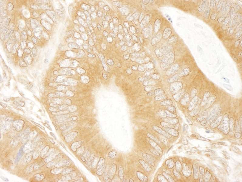 Detection of Human ABC50 by Immunohistochemistry. Sample: FFPE section of human colon carcinoma. Antibody: Affinity purified rabbit anti-ABC50 used at a dilution of 1:250. Epitope Retrieval Buffer-High pH (IHC-101J) was substituted for Epitope Retrieval Buffer-Reduced pH.