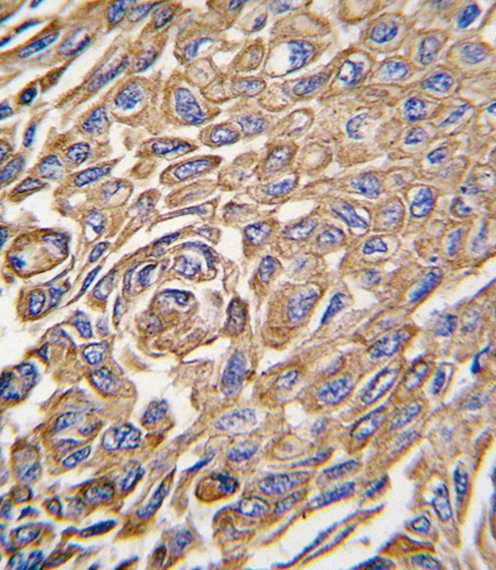 Formalin-fixed and paraffin-embedded human lung carcinoma tissue reacted with ALDH3A1 antibody , which was peroxidase-conjugated to the secondary antibody, followed by DAB staining. This data demonstrates the use of this antibody for immunohistochemistry; clinical relevance has not been evaluated.