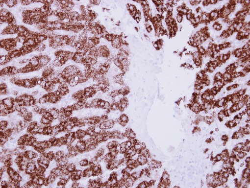 IHC of paraffin-embedded Breast ca, using ALDH6A1 antibody at 1:250 dilution.