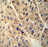 ABCD1 antibody immunohistochemistry of formalin-fixed and paraffin-embedded human hepatocarcinoma followed by peroxidase-conjugated secondary antibody and DAB staining.