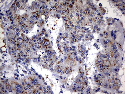 IHC of paraffin-embedded Carcinoma of Human liver tissue using anti-ABCD1 mouse monoclonal antibody. (Heat-induced epitope retrieval by 10mM citric buffer, pH6.0, 120°C for 3min).