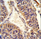 Formalin-fixed and paraffin-embedded human lung carcinoma reacted with ALG14 Antibody , which was peroxidase-conjugated to the secondary antibody, followed by DAB staining. This data demonstrates the use of this antibody for immunohistochemistry; clinical relevance has not been evaluated.
