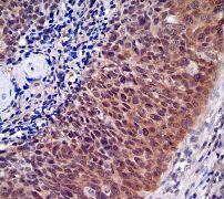 IHC of paraffin-embedded human cervical carcinoma using anti-ABCG1 antibody.