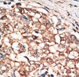 Formalin-fixed and paraffin-embedded human cancer tissue reacted with the primary antibody, which was peroxidase-conjugated to the secondary antibody, followed by DAB staining. This data demonstrates the use of this antibody for immunohistochemistry; clinical relevance has not been evaluated. BC = breast carcinoma; HC = hepatocarcinoma.