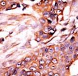 Formalin-fixed and paraffin-embedded human cancer tissue reacted with the primary antibody, which was peroxidase-conjugated to the secondary antibody, followed by AEC staining. This data demonstrates the use of this antibody for immunohistochemistry; clinical relevance has not been evaluated. BC = breast carcinoma;