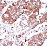 Formalin-fixed and paraffin-embedded human cancer tissue reacted with the primary antibody, which was peroxidase-conjugated to the secondary antibody, followed by DAB staining. This data demonstrates the use of this antibody for immunohistochemistry; clinical relevance has not been evaluated. BC = breast carcinoma; HC = hepatocarcinoma.