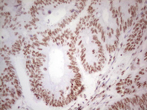 IHC of paraffin-embedded Adenocarcinoma of Human colon tissue using anti-ALKBH1 mouse monoclonal antibody. (Heat-induced epitope retrieval by 1 mM EDTA in 10mM Tris, pH8.5, 120°C for 3min).