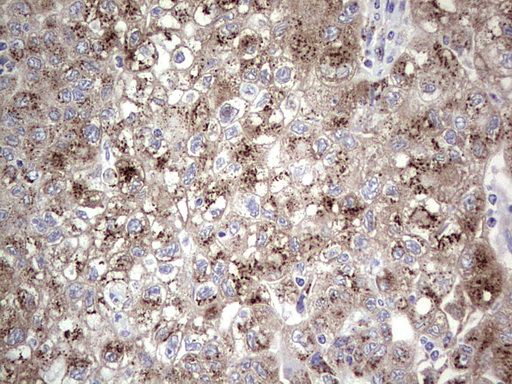 IHC of paraffin-embedded Carcinoma of Human lung tissue using anti-ALKBH1 mouse monoclonal antibody. (Heat-induced epitope retrieval by 1 mM EDTA in 10mM Tris, pH8.5, 120°C for 3min).