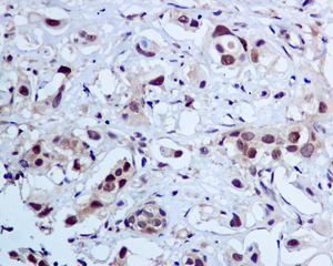 IHC of paraffin-embedded human breast carcinoma tissue using anti-ALKBH antibody.