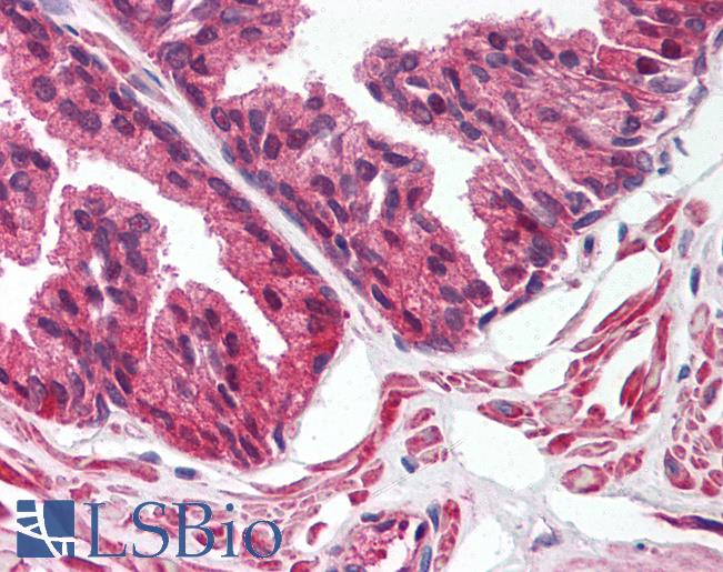 Anti-ALOX15B / 15 Lipoxygenase 2 antibody IHC of human prostate. Immunohistochemistry of formalin-fixed, paraffin-embedded tissue after heat-induced antigen retrieval. Antibody LS-B1588 concentration 5 ug/ml.